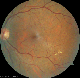 Automatic diagnosis of diabetic retinopathy